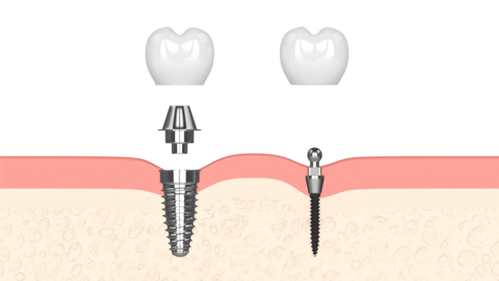 Mini implantes dentales en Norcross, Georgia | Reserve una consulta gratuita