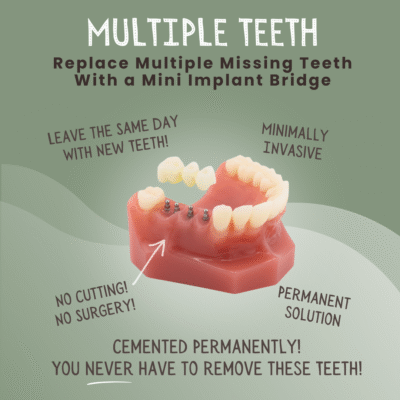 Reemplazo de múltiples dientes en Norcross