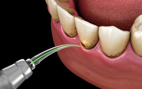 Laser Gum Disease Treatment With Waterlase | Periodontal Disease Options in Norcross, GA