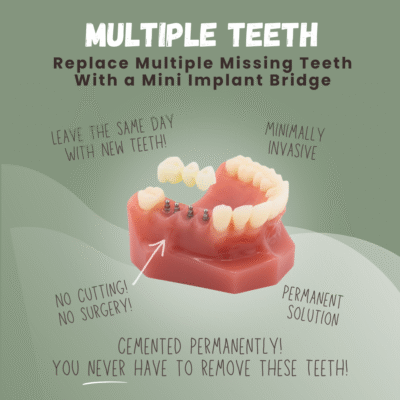 Multiple Tooth Replacement in Norcross