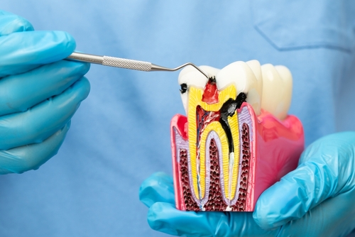 Root Canal Treatment in Norcross, GA | Trusted Dental Care