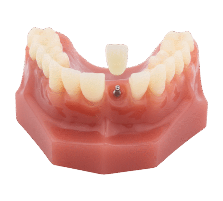 Same-Day Dental Implants in Norcross, GA | Free Screenings