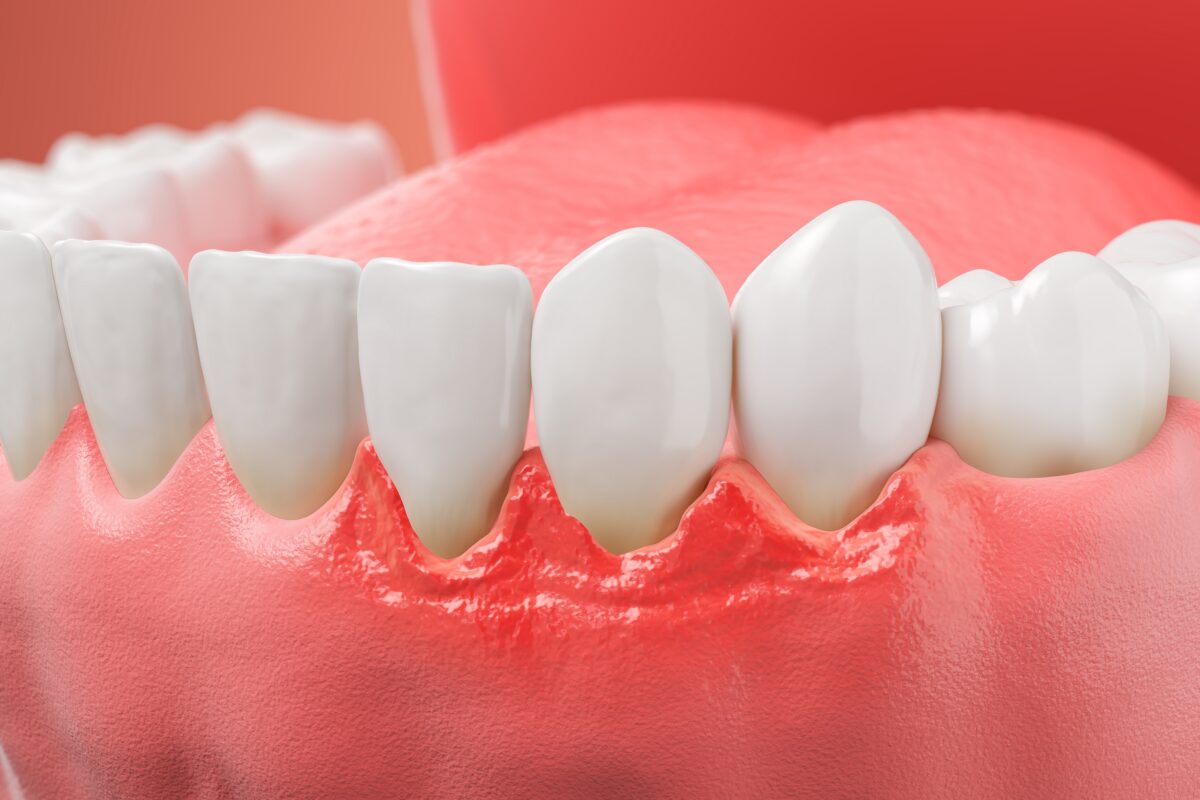 Waterlase in Norcross, GA | Free Screening for Gum Disease