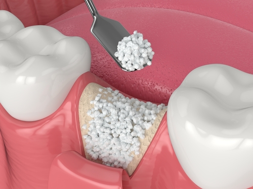 Bone Grafting for Dental Implants in Norcross, GA [Video Explainer]