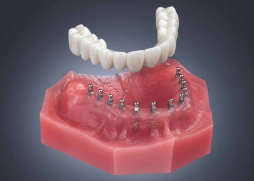 Denture Options in Norcross, GA | Free Screening [Video Guide]
