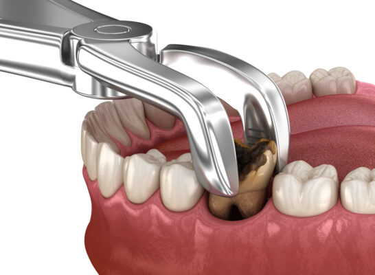 Dental Extraction in Norcross, GA | Free Screening [Video Guide]