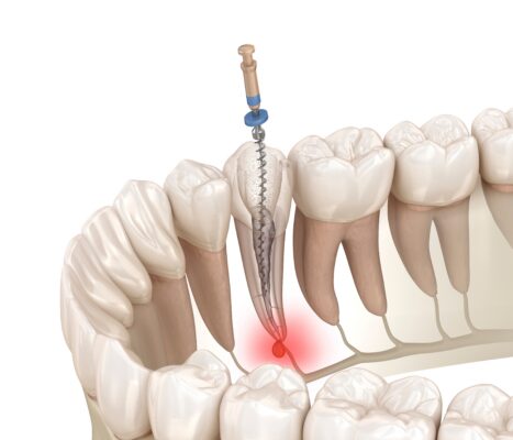 Root Canal in Norcross, GA | Free Screening [Video Breakdown]