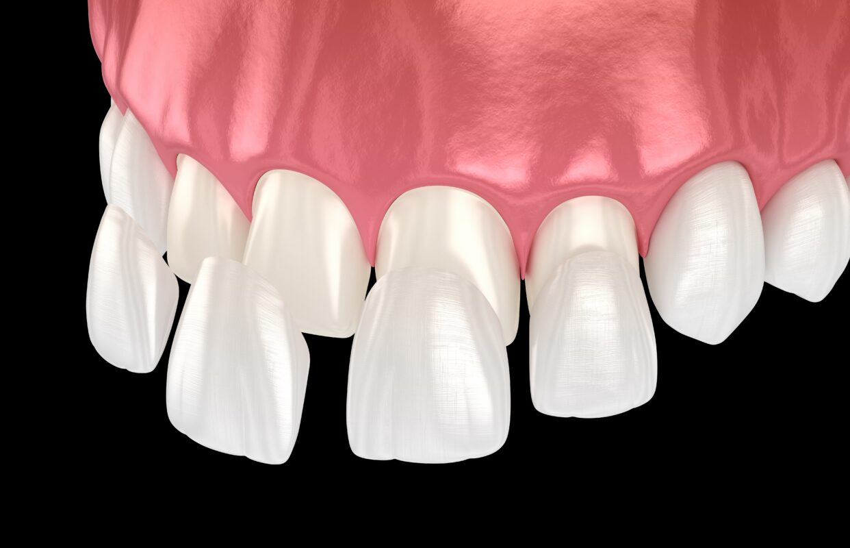 Relleno dental vs. carillas en Cleveland, TN [Video adjunto] 😁