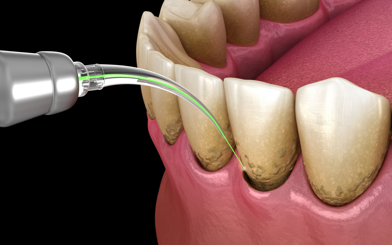 Laser Gum Disease Treatment in Norcross | Free Screening [Video]