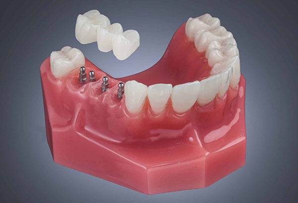 Implant Bridge in Norcross | Free Screening Included [Video Q&A]
