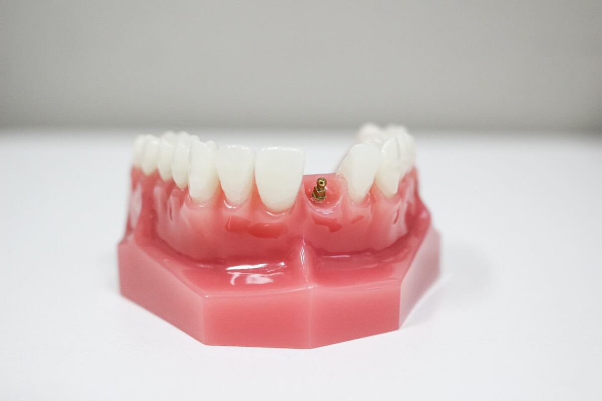 Minimally Invasive Dental Implants in Norcross, GA [Video Guide]