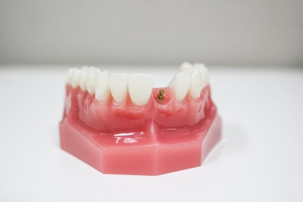 Minimally Invasive Dental Implants in Norcross, GA [Video Guide]