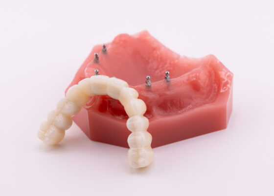 Roundhouse Bridge in Norcross, GA | Dental Implant [Video Guide]