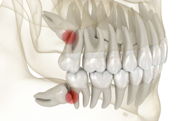 Wisdom Tooth Extraction in Norcross, GA [Video Explainer] 🦷