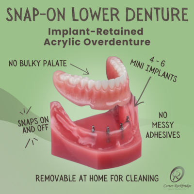 Snap-On Dentures in Norcross, GA | Mini Implant [Video Explainer]