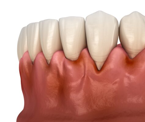Signs of Gum Disease in Norcross, GA | Book a Free Screening 🦷