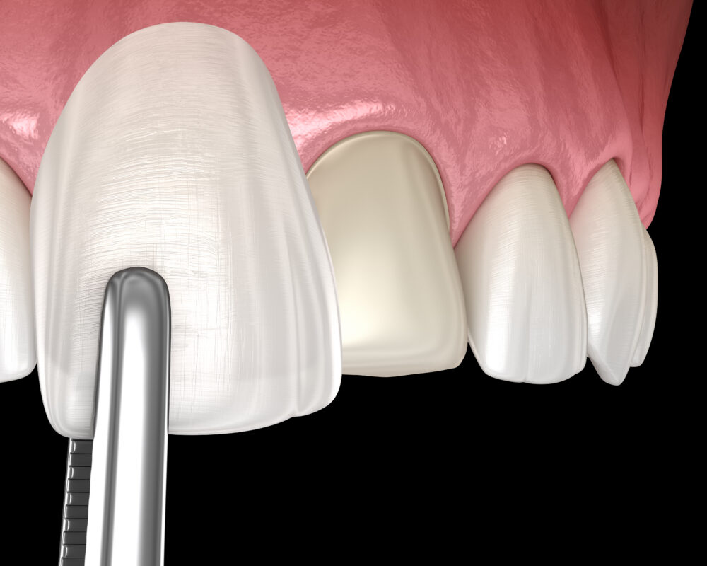 Veneers vs. Crowns in Norcross, GA | Free Screening [Video Q&A]