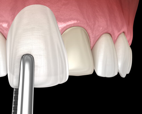 Veneers vs. Crowns in Norcross, GA | Free Screening [Video Q&A]
